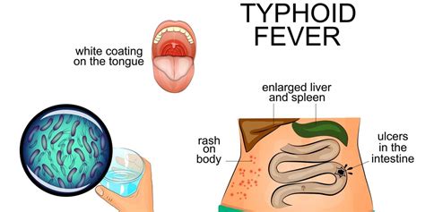 Image result for Typhoid Fever Disease