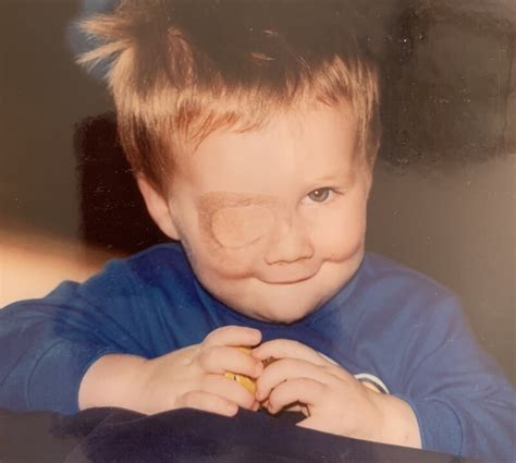 Light Blue Eyes Albinism に対する画像結果