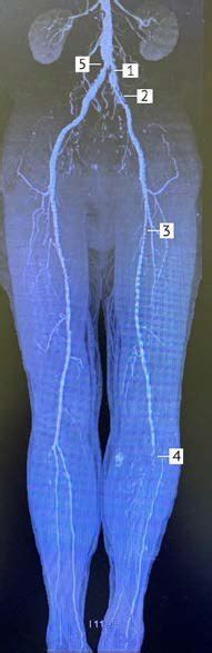 Lower Extremity Angiogram Procedure に対する画像結果