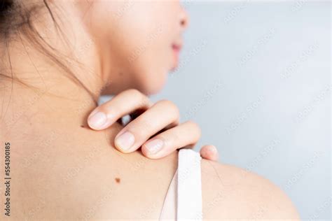 Afbeeldingsresultaten voor Mole On Neck