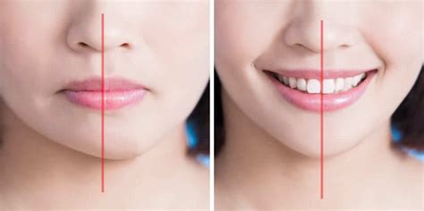 Image result for Asymmetrical Smile