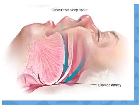 Sleep Apnea Diagram ପାଇଁ ପ୍ରତିଛବି ଫଳାଫଳ