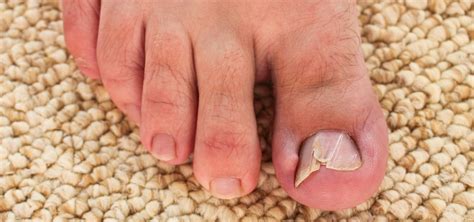 Image result for Toenail Problems