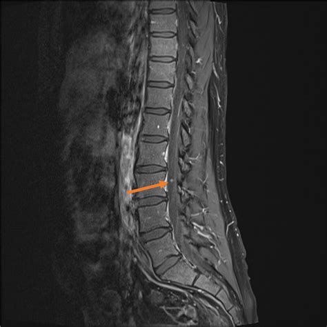 Abnormal MRI Lumbar Spine に対する画像結果