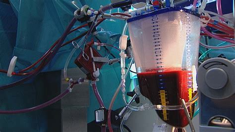 Image result for Transfusioner