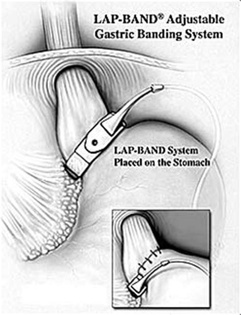 Image result for Lap Band Logo