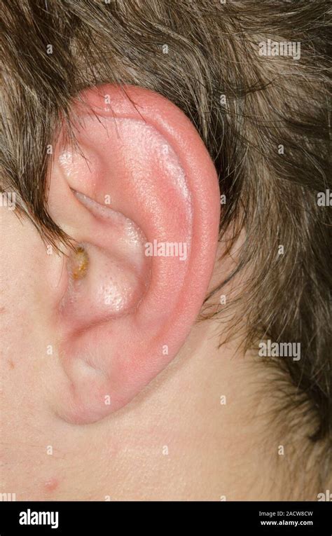 Image result for Auricular Cellulitis