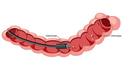Image result for Colonoscopy Mins