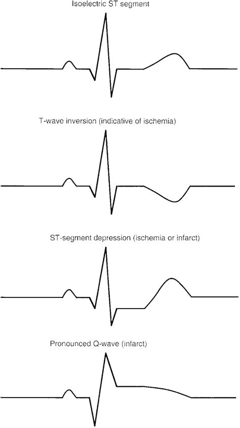 Afbeeldingsresultaten voor Normal ECG Trace