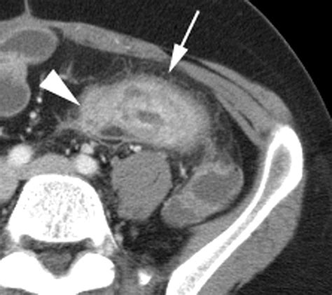 Image result for CT Enterography