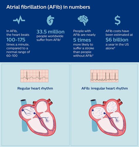 Image result for Cardiac Output in AFib