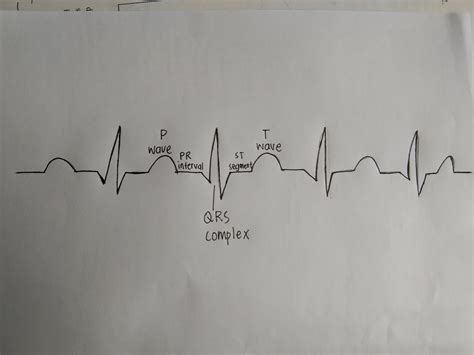 Image result for Sinus Rhythm Diagram Unlabelled