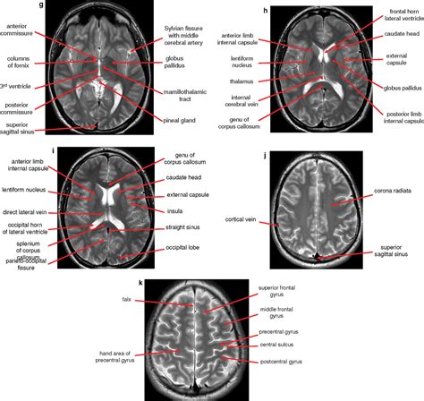Image result for Normal Brain MRI Axial Labelled