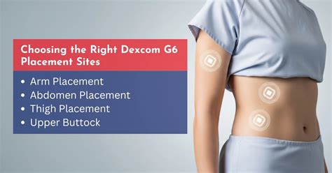 Dexcom G6 Placement Sites: Arm, Abdomen, Buttock or Thigh