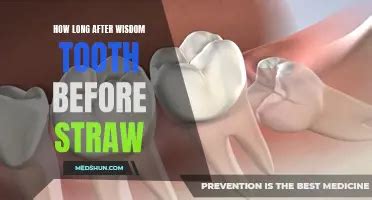 Toradh íomhá ar Extracting a Wisdom Tooth