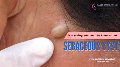 Image result for Lancing a Sebaceous Cyst