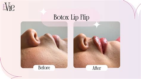 Image result for Botox and Lip Flip Flyer