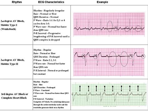 Afbeeldingsresultaten voor ACLS Rhythm Identification Cheat Sheet