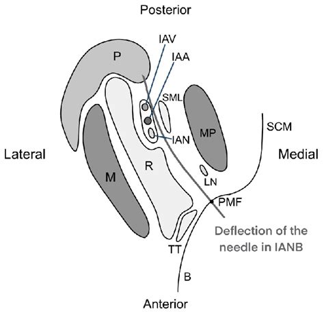 Image result for Minimizing Needle Deflection