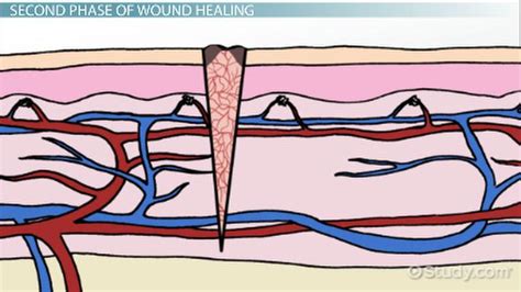 Image result for Wound Maturation Phase Example