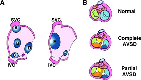 Toradh íomhá ar Atrial Septal Defect Classification