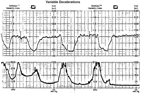 Velocity Time Graph with Variable Deceleration に対する画像結果