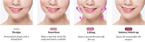 Image result for Thread Lifting Procedure