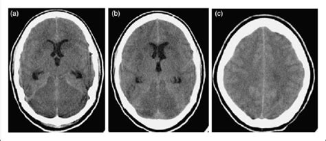 Image result for Acute Confusion State in Children