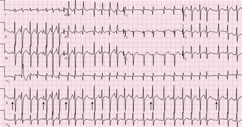 Afbeeldingsresultaten voor EKG Practice Test Questions