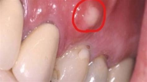 Abscess Tooth Symptoms - Pediatric Dentist In Monroe, NC