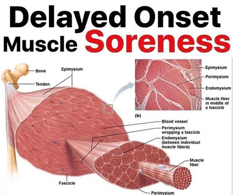 Delayed Muscle Onset に対する画像結果