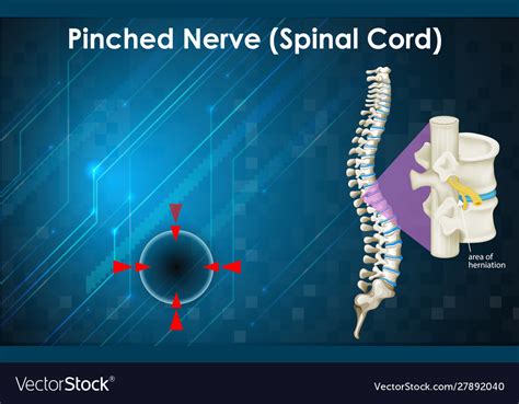 Image result for Pin Nerve