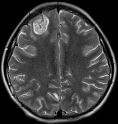 Image result for Ruis Atrium Septum Defect