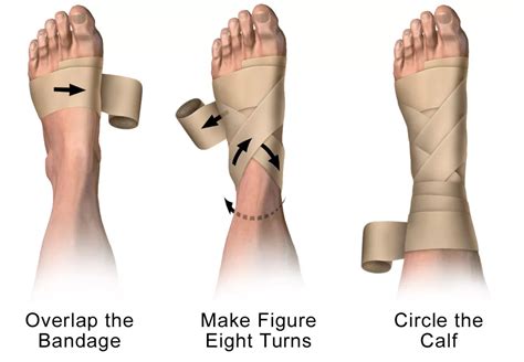 Toradh íomhá ar How to Wrap Ankle Sprain
