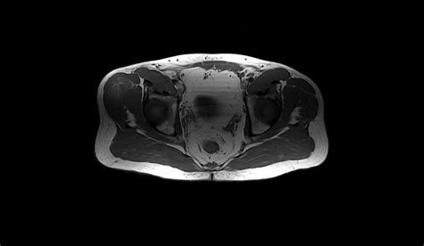 Sarcoma MRI に対する画像結果