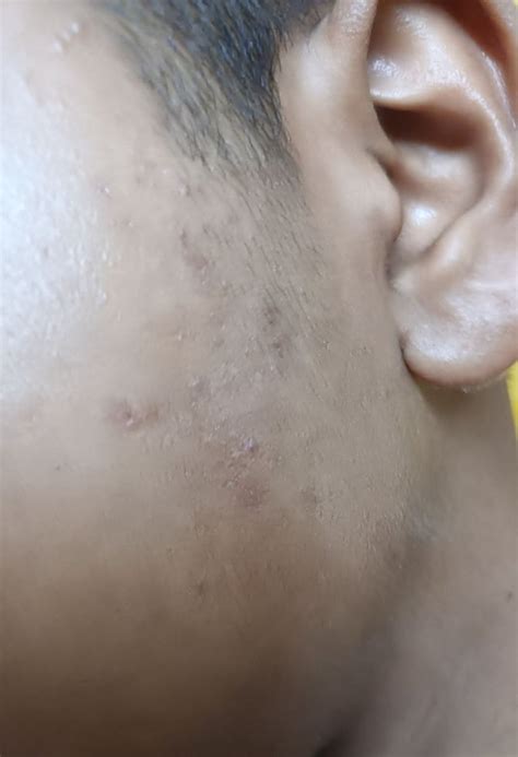 Image result for Closed Comedones Nose Nose