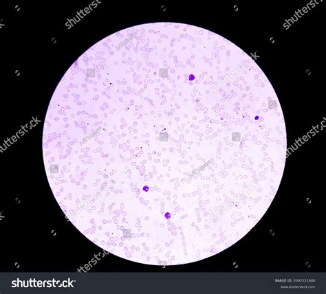 5 Dimorphic rbc Images, Stock Photos & Vectors | Shutterstock