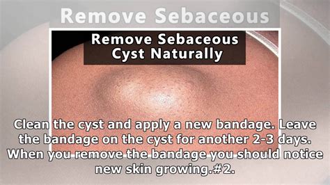 DIY Remove Sebaceous Cyst に対する画像結果