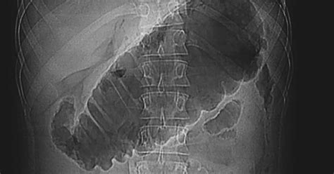 Toxic Megacolon Next to Normal に対する画像結果
