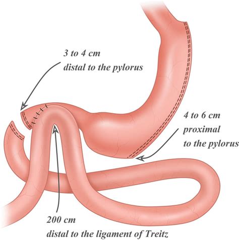 Toradh íomhá ar Sleeve Bypass
