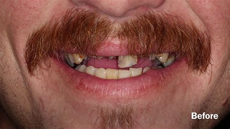 Image result for Broken Decayed Tooth