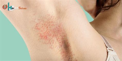 Image result for Painful Pimple Under Armpit