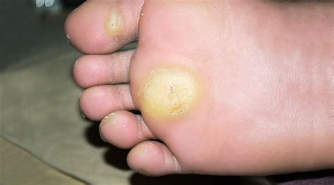 Image result for Foot Callus Pattern