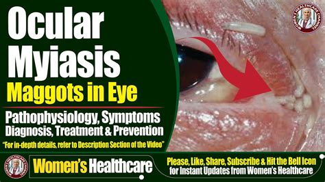 Afbeeldingsresultaten voor Myiasis Maggots