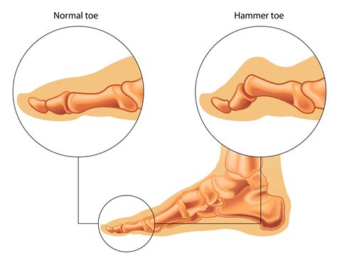 Image result for Hammer Toe Problems
