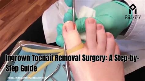 Ingrown Toenail Removal Surgery: A Step-by-Step Guide