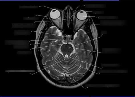 Image result for Normal Brain MRI Axial Labelled