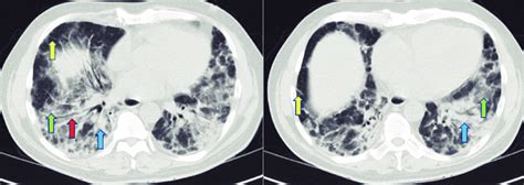 Image result for High Resolution CT Scan