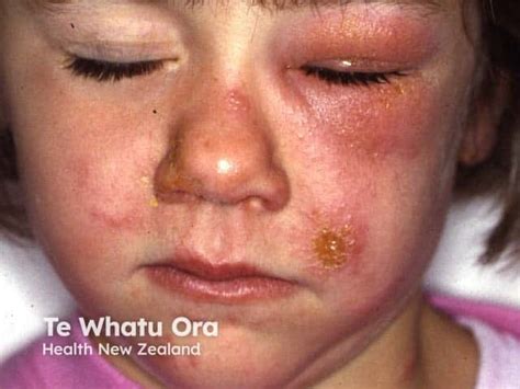 Rhus Dermatitis Face-এর ছবি ফলাফল
