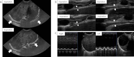 Toradh íomhá ar Eventration of Diaphragm Neonate